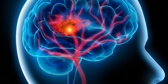 Stroke treatment and hospital liabiltiy